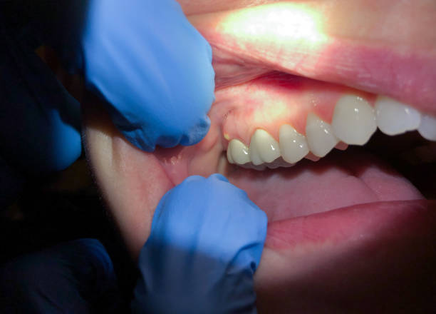 Best Emergency Treatment for Dental Infections or Abscesses in Waggaman, LA